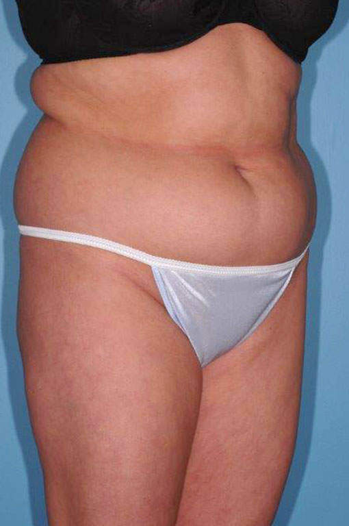 Tummy Tuck Before and After 48