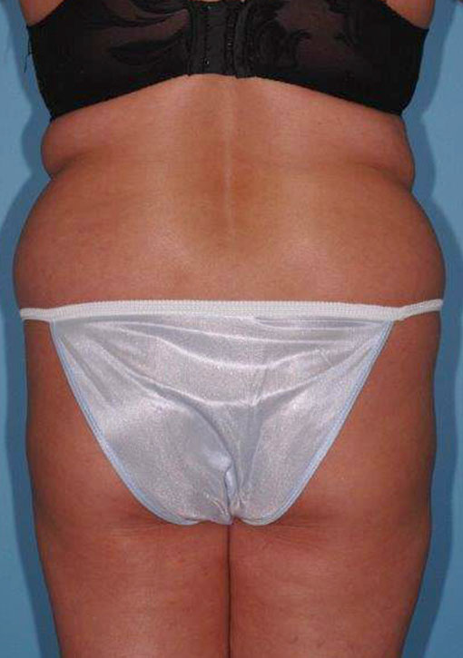 Tummy Tuck Before and After 48