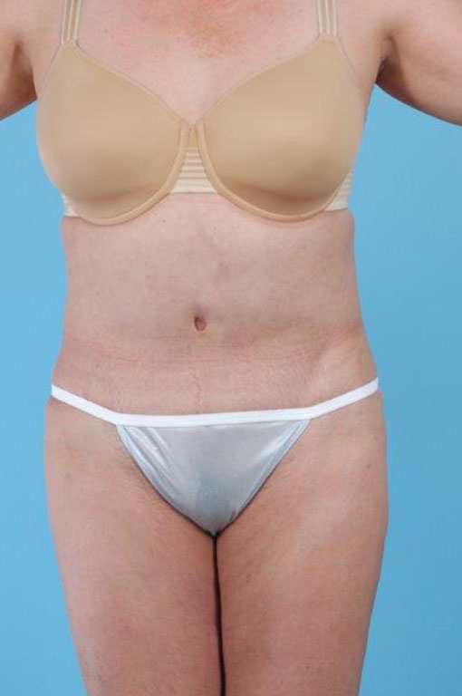 Tummy Tuck Before and After 49