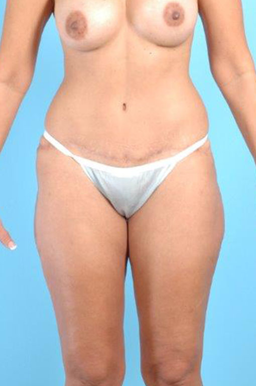 Tummy Tuck Before and After 42