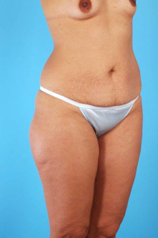 Tummy Tuck Before and After 50