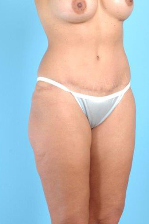 Tummy Tuck Before and After 50