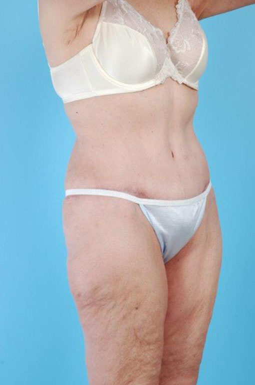 Tummy Tuck Before and After 51