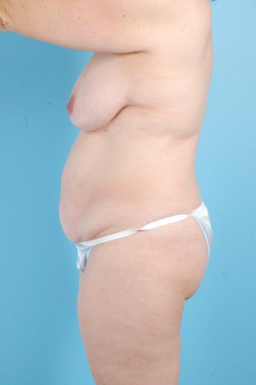Tummy Tuck Before and After 54