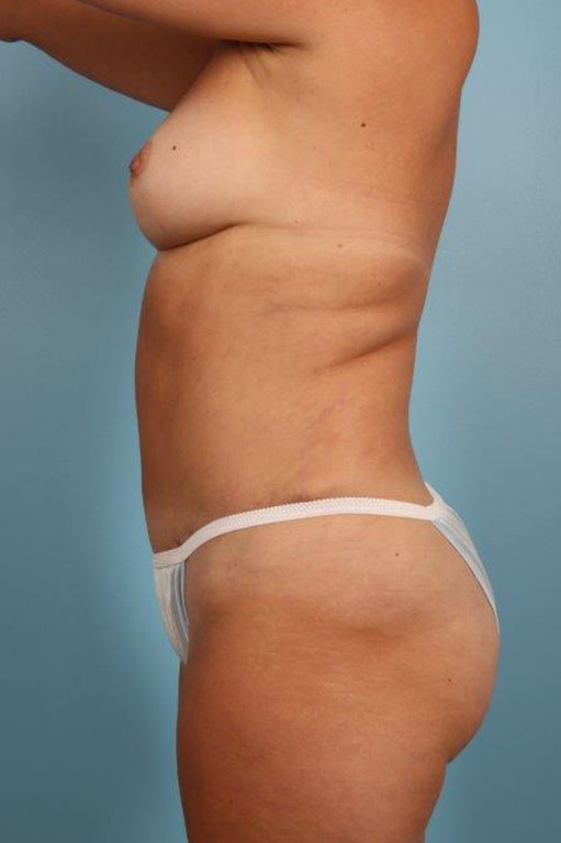 Tummy Tuck Before and After 55