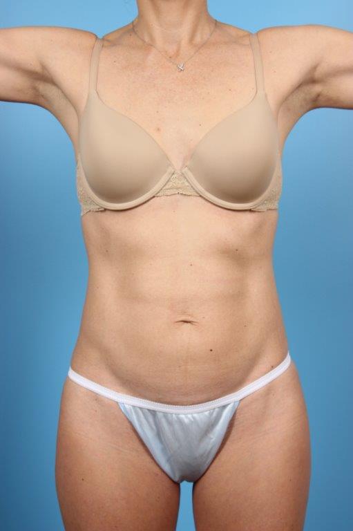Tummy Tuck Before and After 56