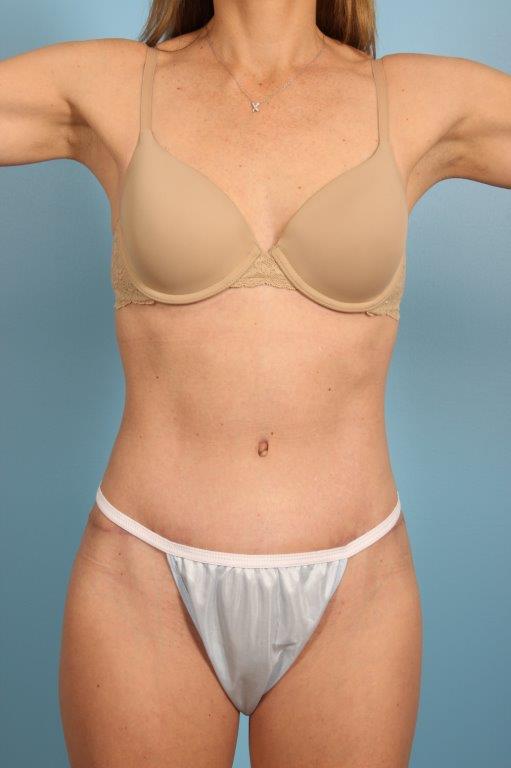 Tummy Tuck Before and After 42