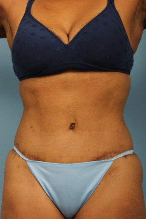 Tummy Tuck Before and After 45