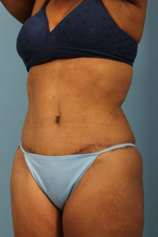 Tummy Tuck Before and After 58