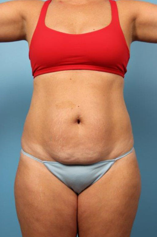 Tummy Tuck Before and After 60