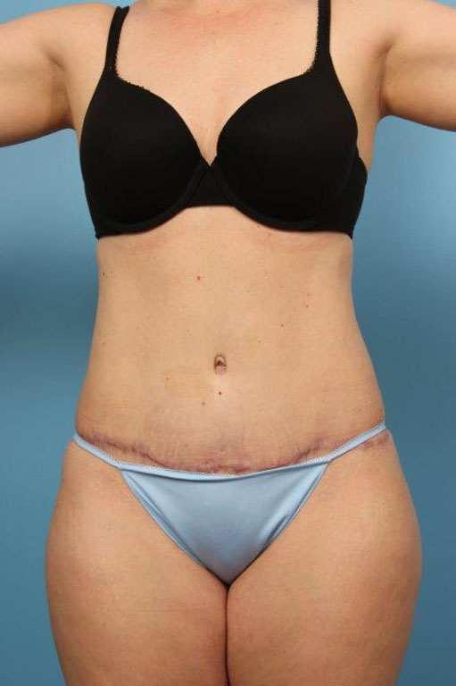 Tummy Tuck Before and After 60