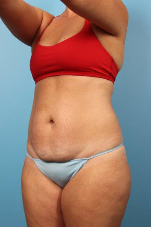 Tummy Tuck Before and After 60