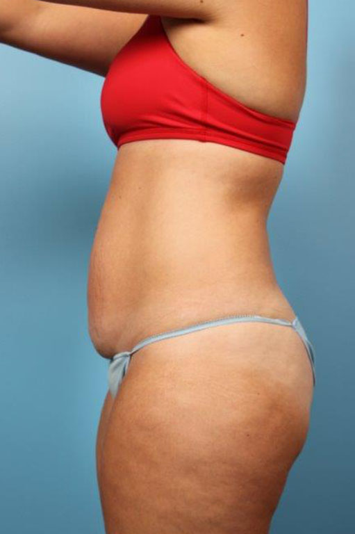 Tummy Tuck Before and After 60