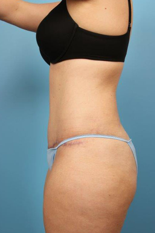 Tummy Tuck Before and After 60