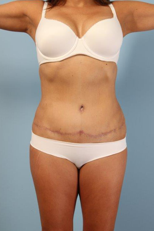 Tummy Tuck Before and After 38