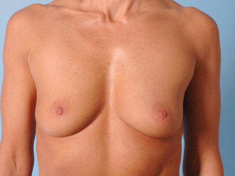 Breast Augmentation Saline Before and After 01