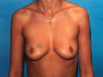 Breast Augmentation Saline Before and After 05