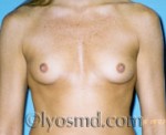 Breast Augmentation Saline Before and After 06