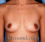 Breast Augmentation Saline Before and After 07