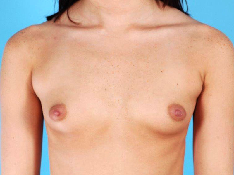Breast Augmentation Saline Before and After 09