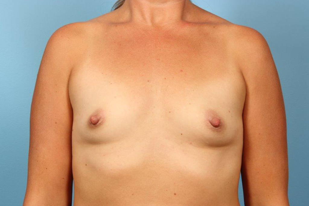 Breast Augmentation Silicone Before and After 02