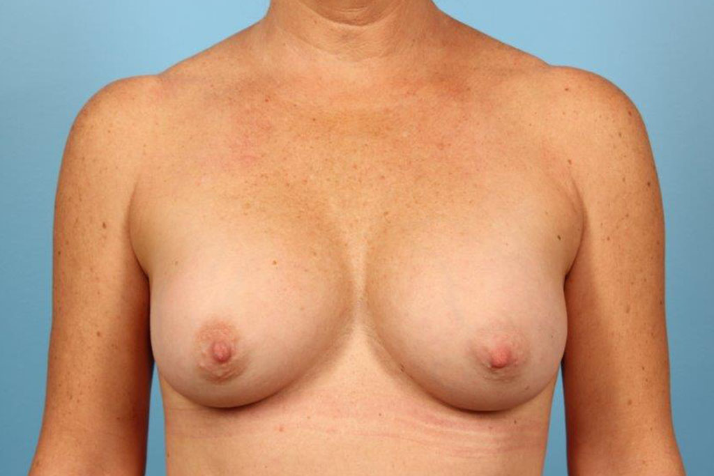 Breast Augmentation Silicone Before and After 06