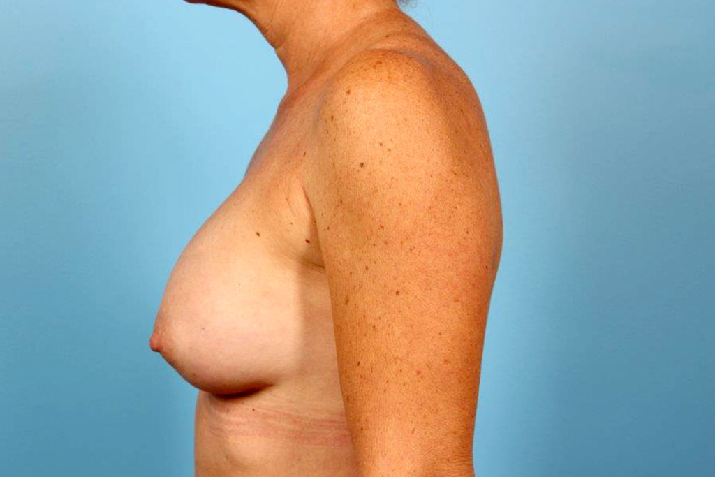 Breast Augmentation Silicone Before and After 05