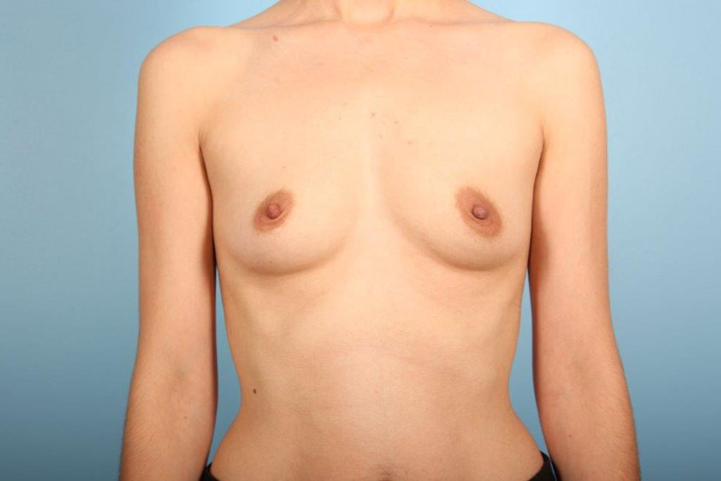 Breast Augmentation Silicone Before and After 10