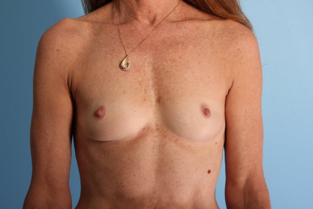 Breast Augmentation Silicone Before and After 11