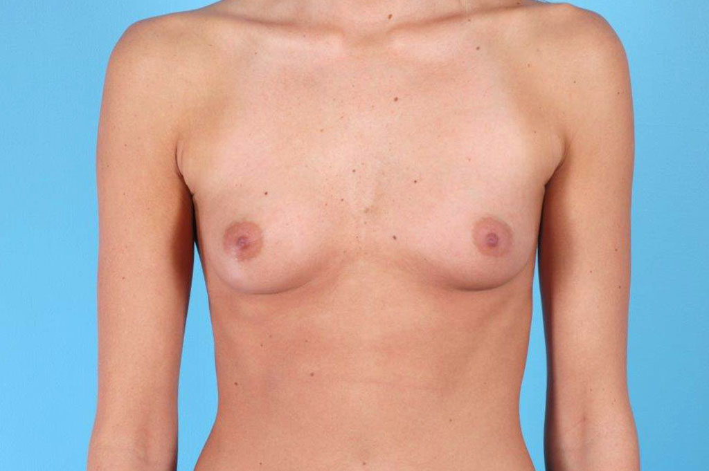 Breast Augmentation Silicone Before and After 15