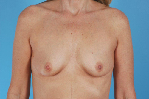 Breast Augmentation Silicone Before and After 21