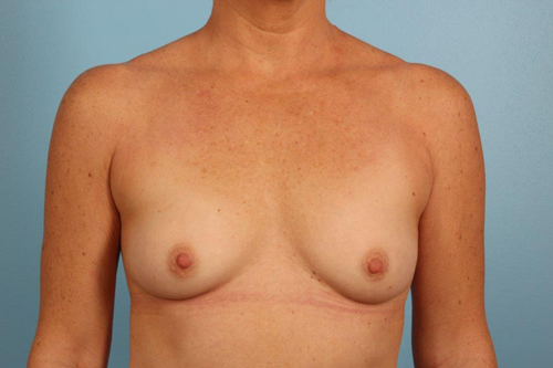 Breast Augmentation Silicone Before and After 22