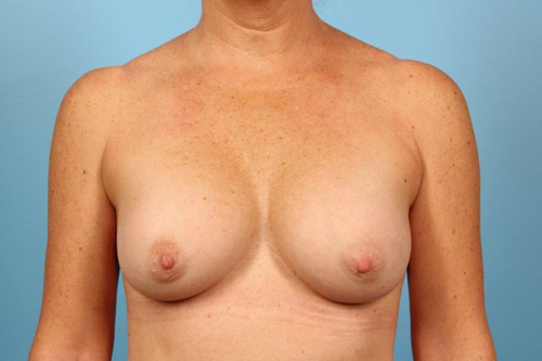 Breast Augmentation Silicone Before and After 13