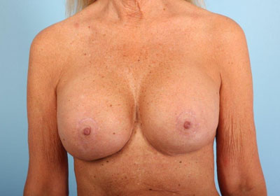 Breast Implant Revision Before and After 04