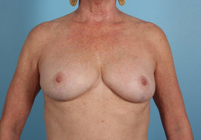 Breast Lift Before and After 08