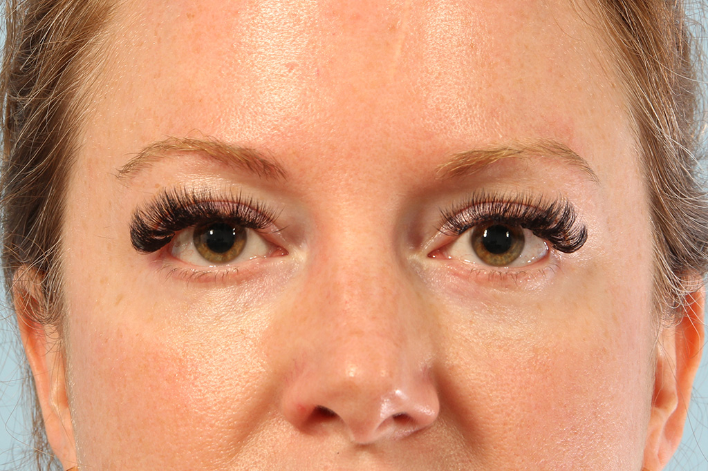 Blepharoplasty Before and After 03