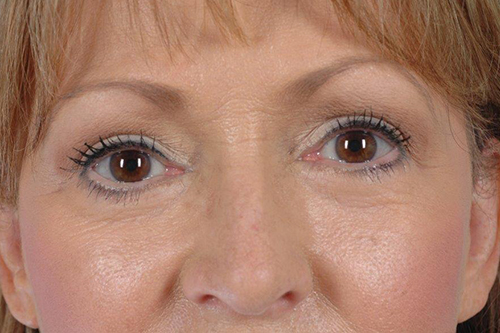 Blepharoplasty Before and After 06