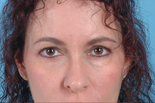 Blepharoplasty Before and After 07