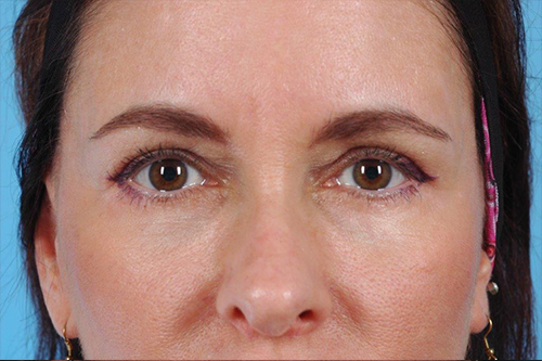 Blepharoplasty Before and After 11