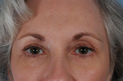 Blepharoplasty Before and After 11
