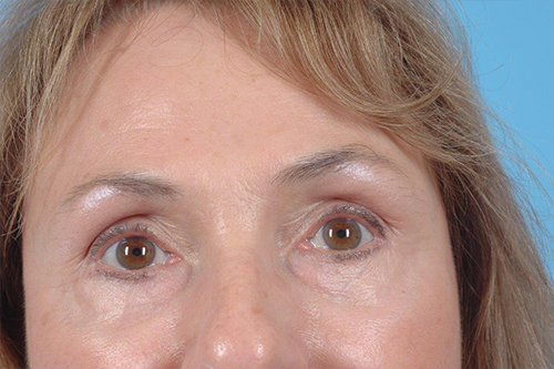 Blepharoplasty Before and After 06