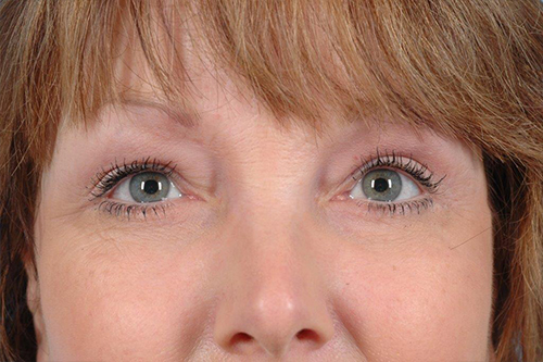 Blepharoplasty Before and After 12