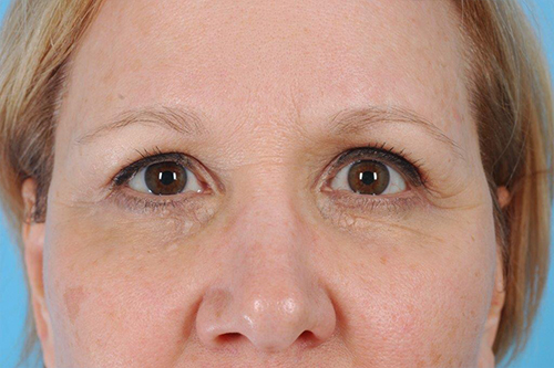 Blepharoplasty Before and After 04