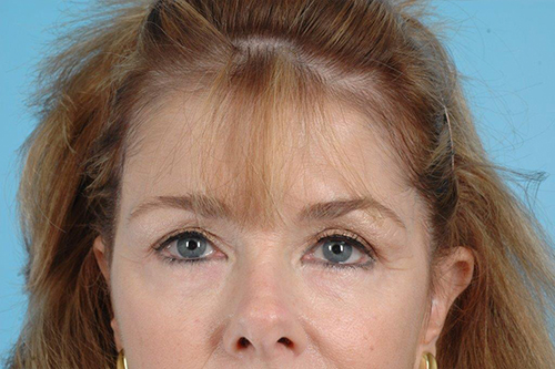 Blepharoplasty Before and After 10