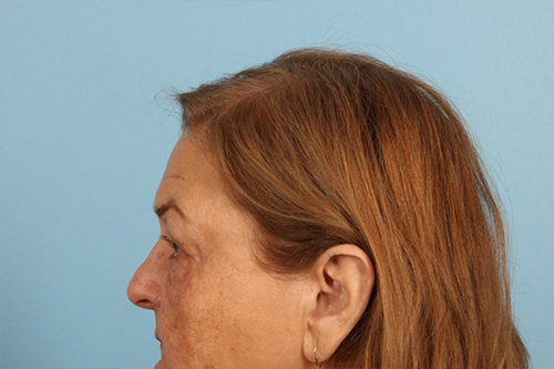 Blepharoplasty Before and After 15