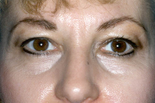 Blepharoplasty Before and After 16