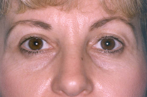 Blepharoplasty Before and After 12