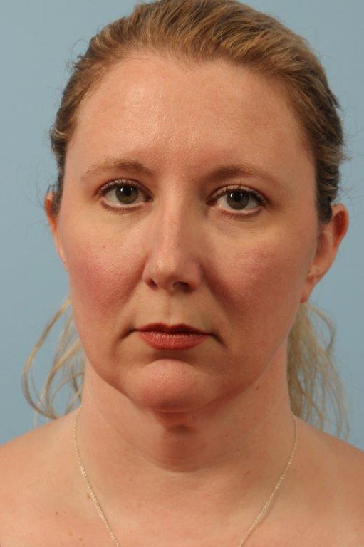 Brow Lift Before and After 02