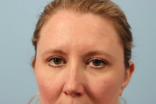 Brow Lift Before and After 02