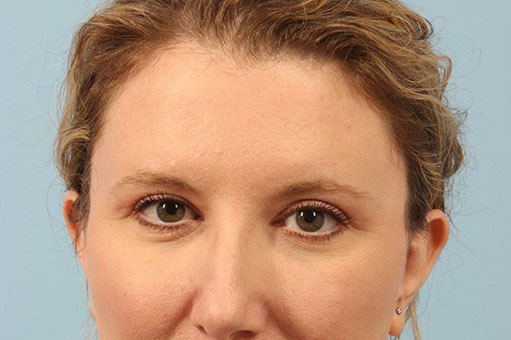 Brow Lift Before and After 02